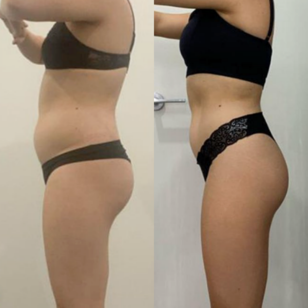 Estro Physiques client transformation